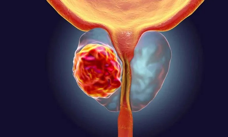 Cáncer de próstata tratado con microablación no afecta funciones del hombre